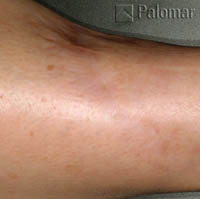 Laser Skin Resurfacing Behandlung von Narben Vorher/Nachher Bilder
