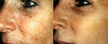 Vorher-nachher-Bilder einer erfolgreichen Entfernung von Pigmentflecken bei einer Patientin von S-thetic Derma