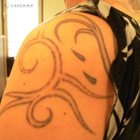 Tribal-Tattoo auf dem Rücken und der Schulter einer jungen Frau vor der Tattooentfernung bei S-thetic Derma in Berlin