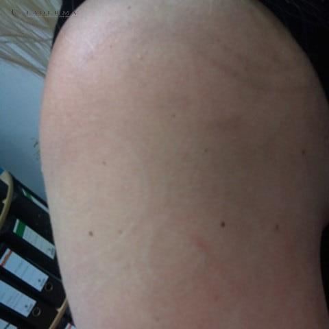 Ergebnis eines entfernten Tribal-Tattoos auf dem Rücken und der Schulter einer jungen Frau